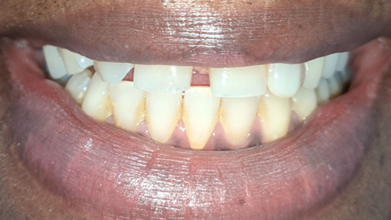 Removable Partial - Tooth Replacement Option