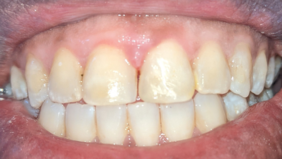 Before after images of Chipped Tooth Repair
