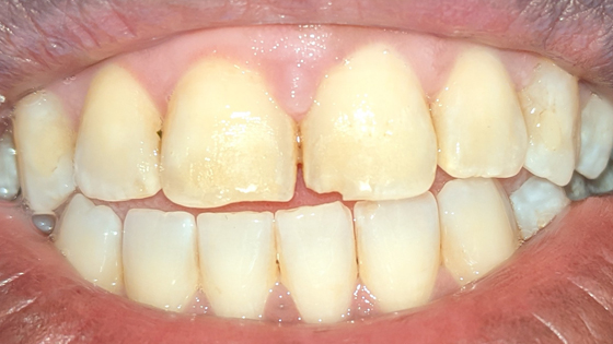 Chipped Tooth Repair Before Treatment