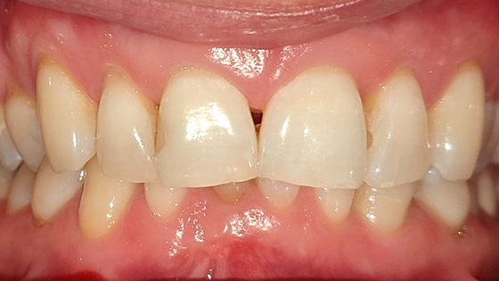 Before After Images of Invisalign Treatment