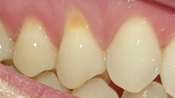 Composite Dental Filling at Relate Dental Care
