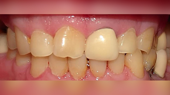 before and after images of teeth whitening in Culver City