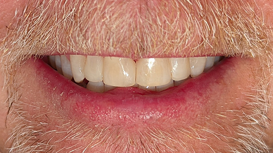 dental veneers results at Relate Dental Care